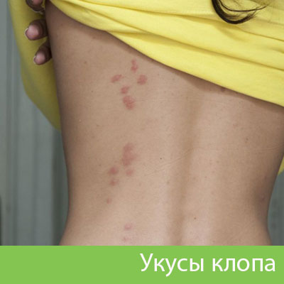 Профессиональное уничтожение клопов в Тольятти